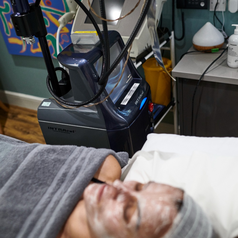 Microneedling Weybridge With INTRAcel Light Touch Clinic Microneedling Weybridge With INTRAcel Light Touch Clinic