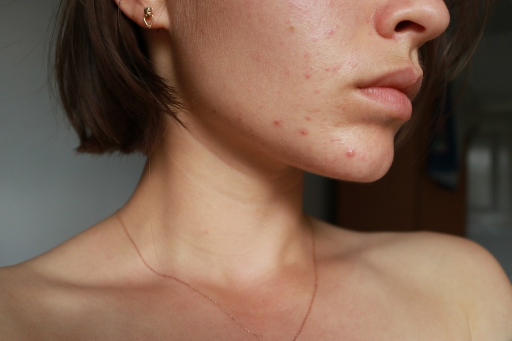 Acne on skin
