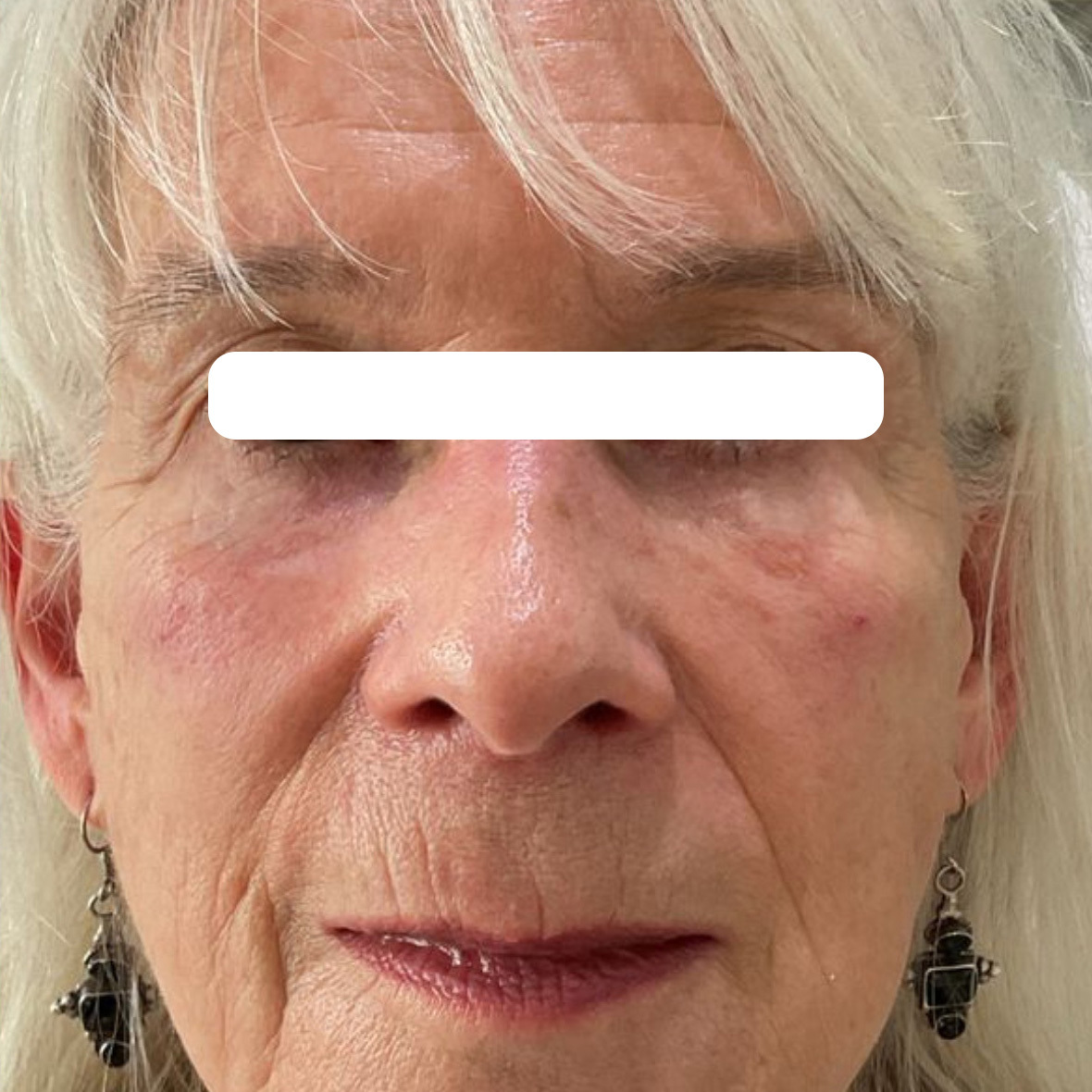 tear trough fillers after