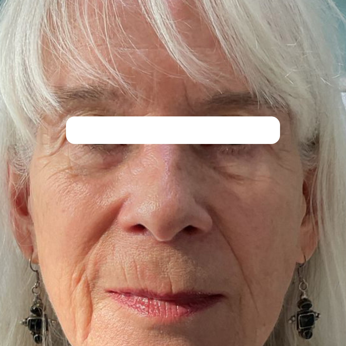 tear trough fillers before