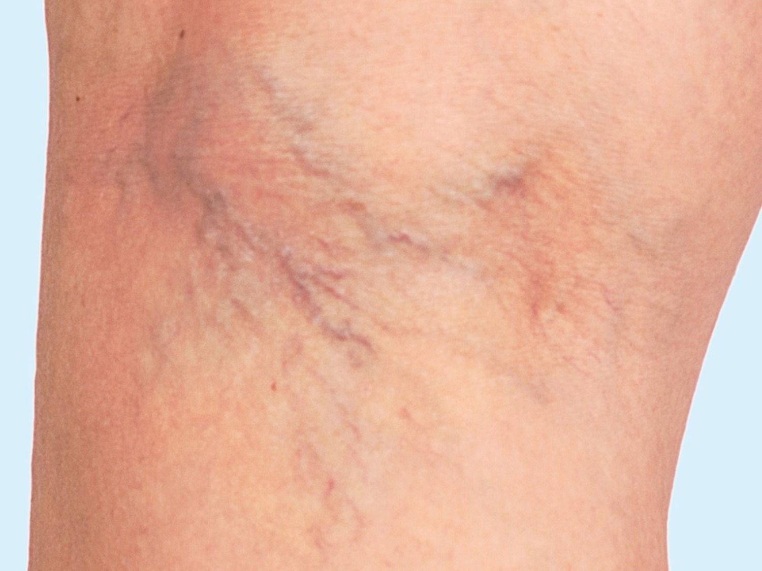 Thread vein on legs