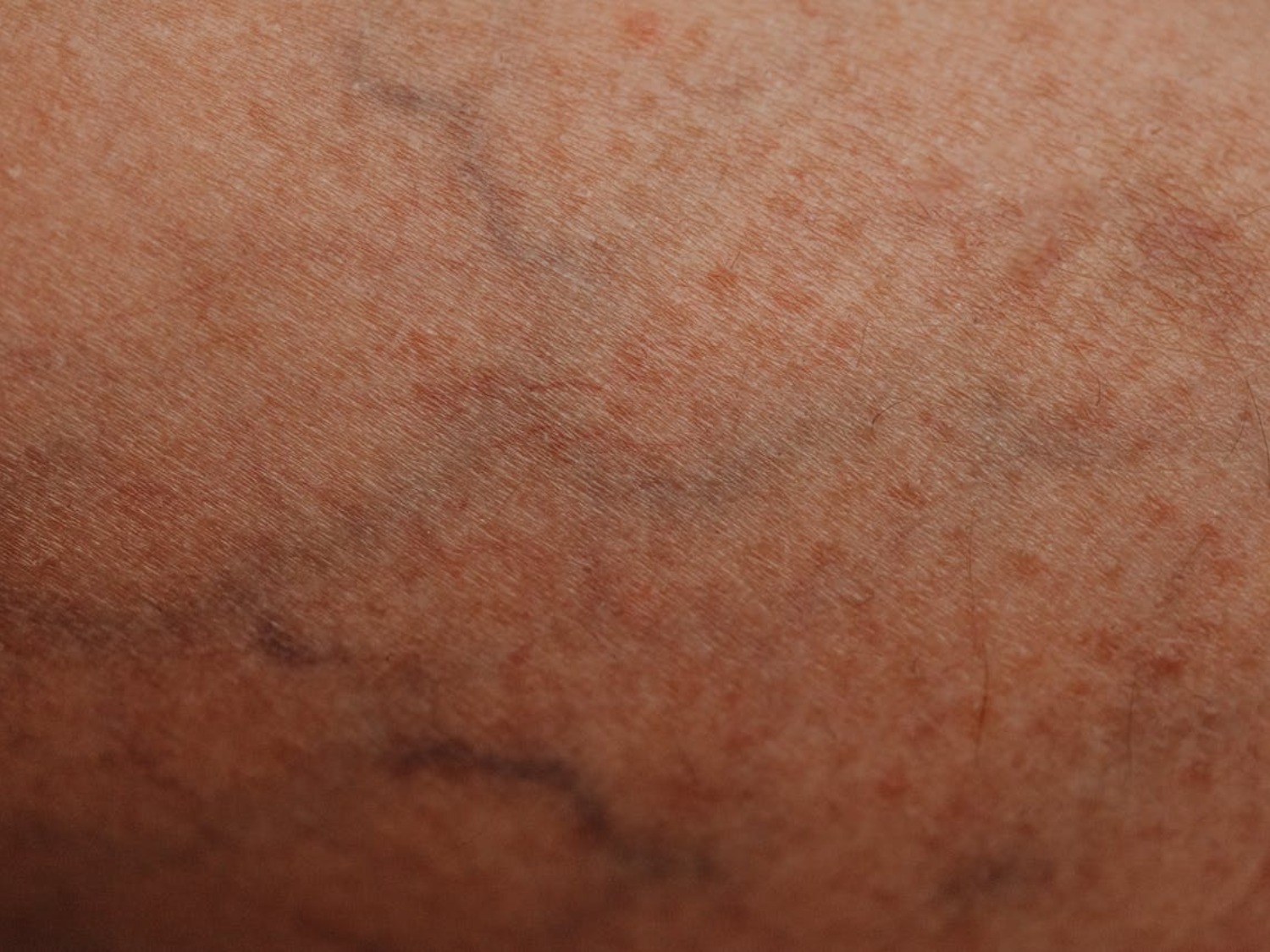 Thread Veins on Skin