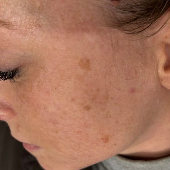 Before IPL Treatment