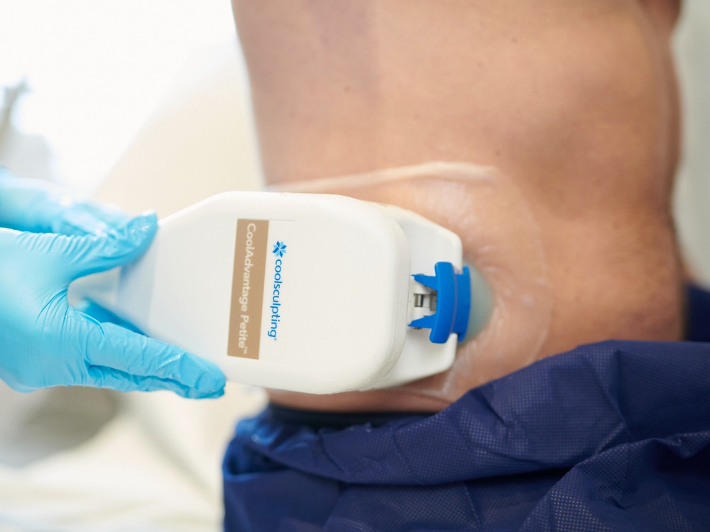 CoolSculpting Treatment