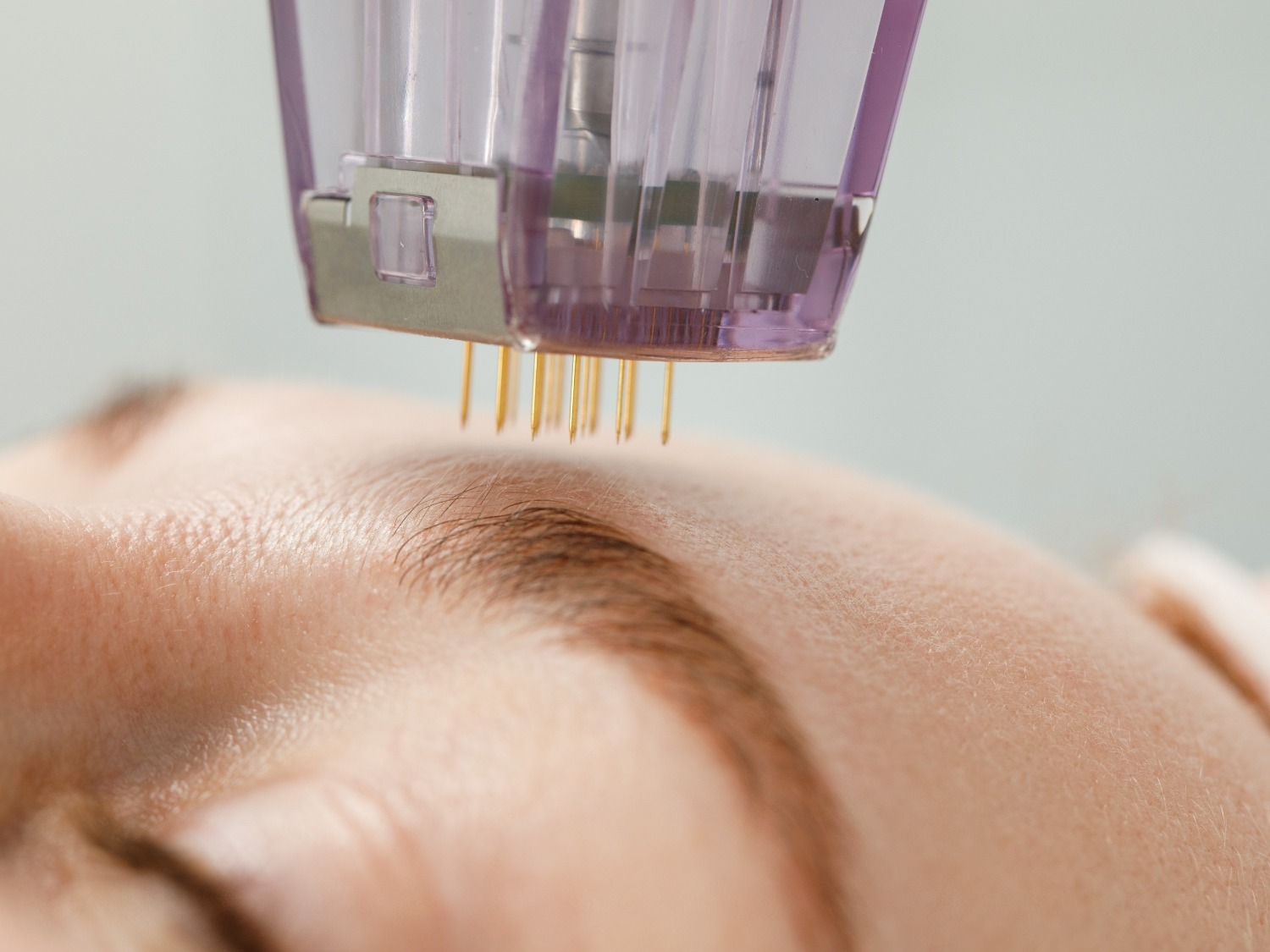 Microneedling Needles