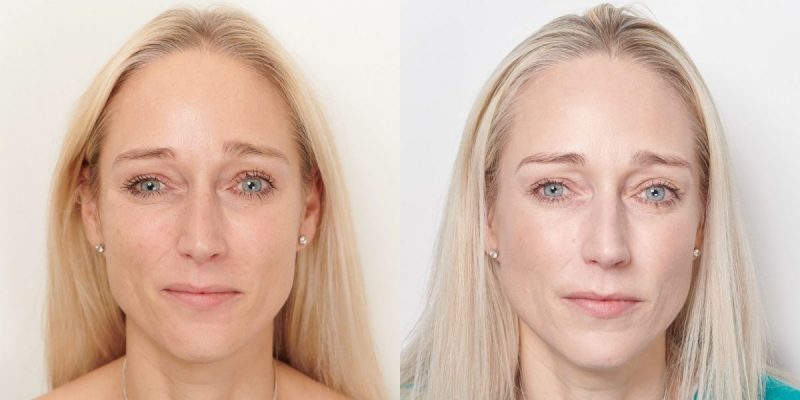 Profhilo Before & After | Light Touch Clinic