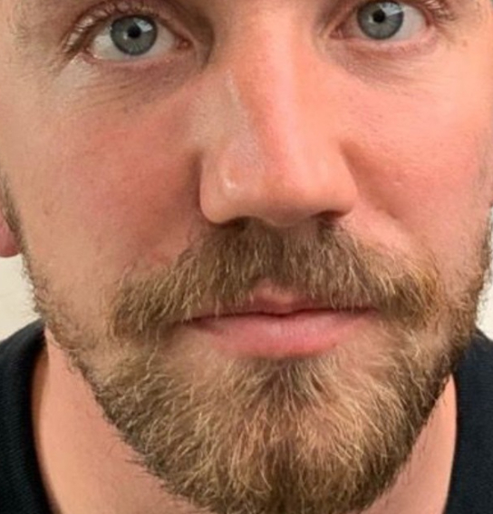 A man after dermal fillers