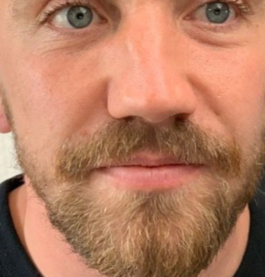 A man before dermal fillers.