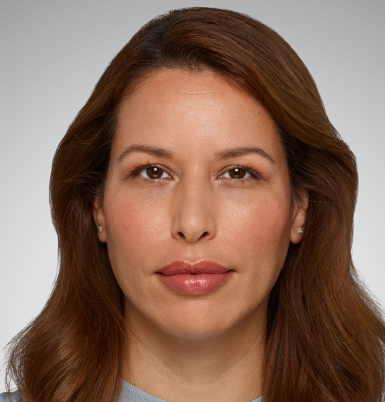 After Dermal Fillers