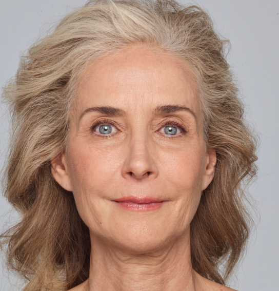 After Dermal Fillers