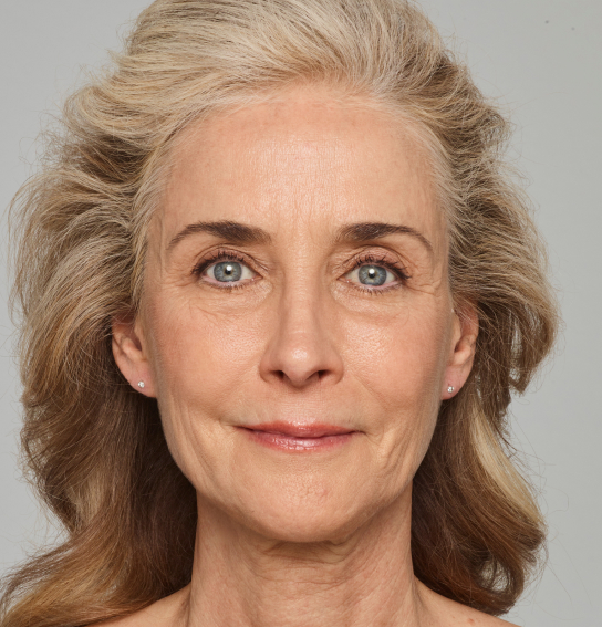 After Dermal Fillers