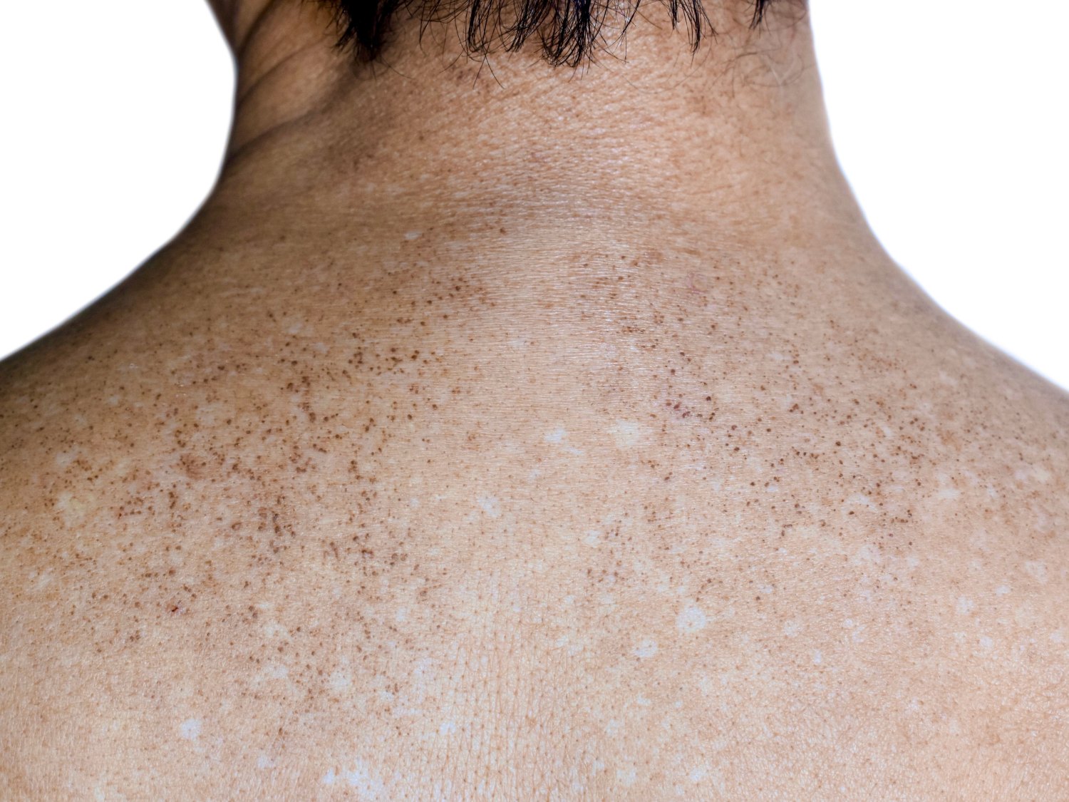 Sun spots on upper back
