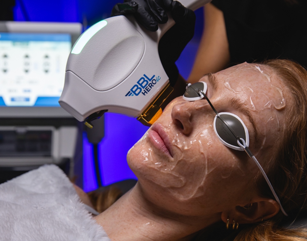 BBL HEROic Treatment on Woman BBL HEROic Treatment on Woman