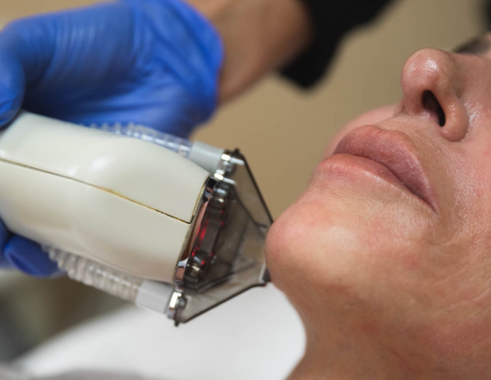 Moxi Laser Treatment