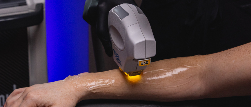 Sciton BBL HEROic on Arm