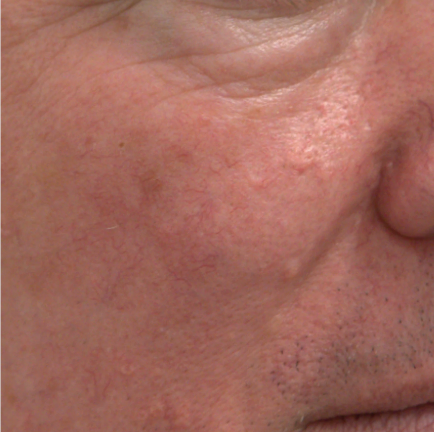 After Rosacea