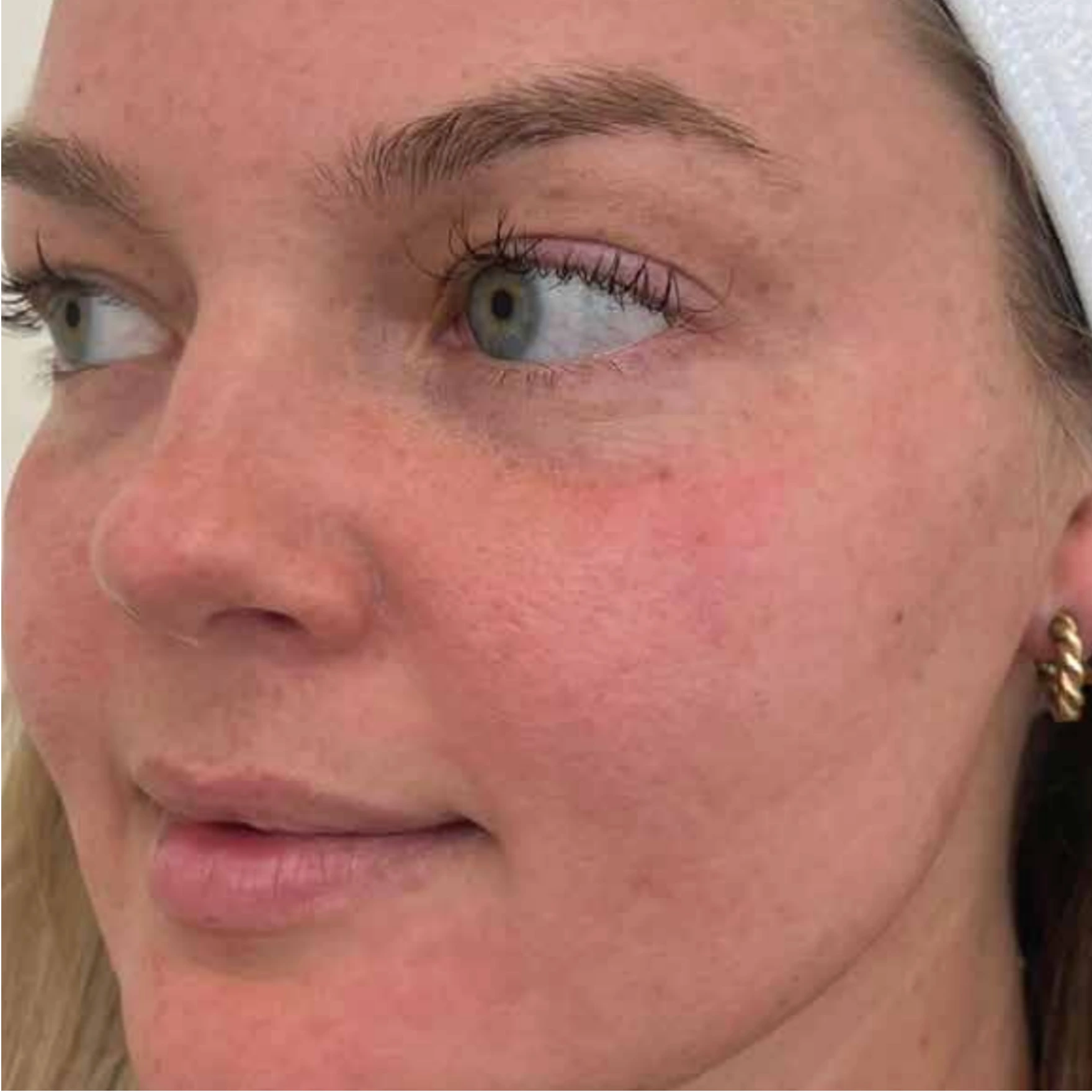 After Pigmentation BBL