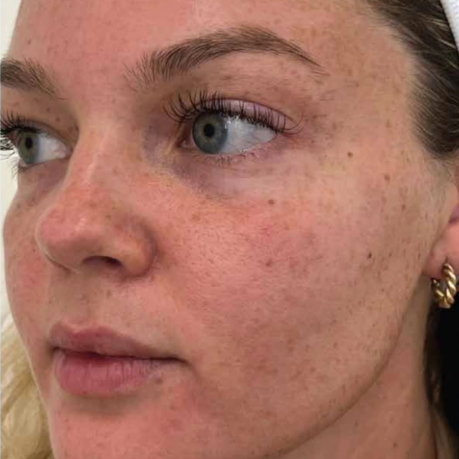 Before Pigmentation BBL