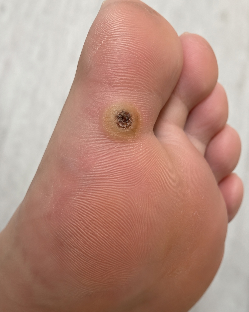 Verruca on someone's foot.