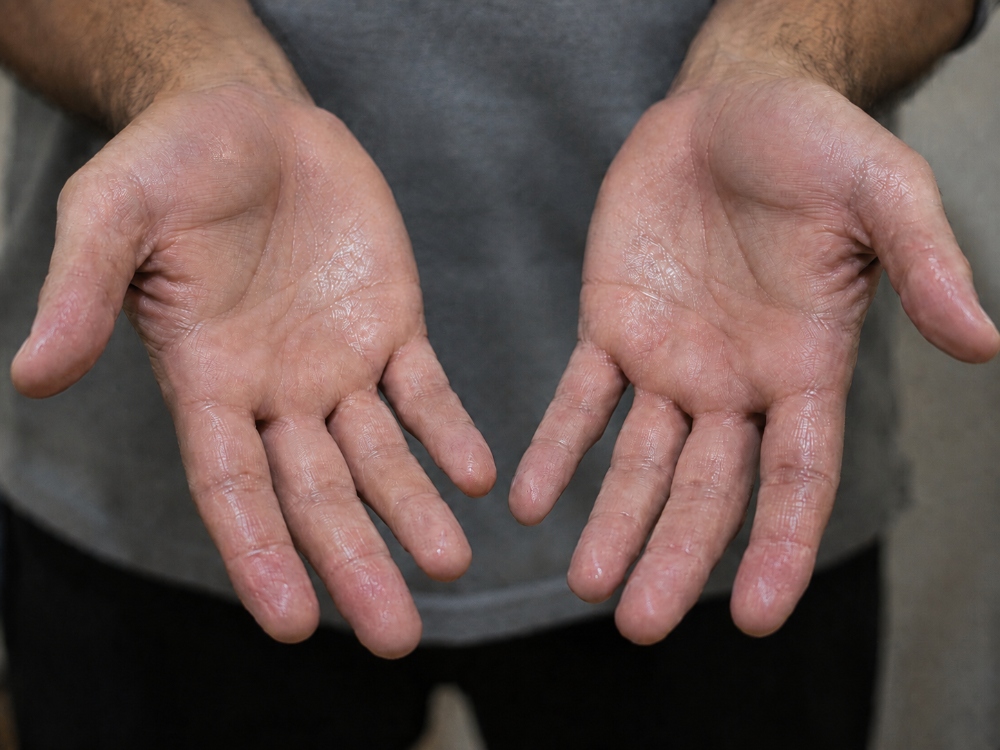 A man's hand with sweaty palms.