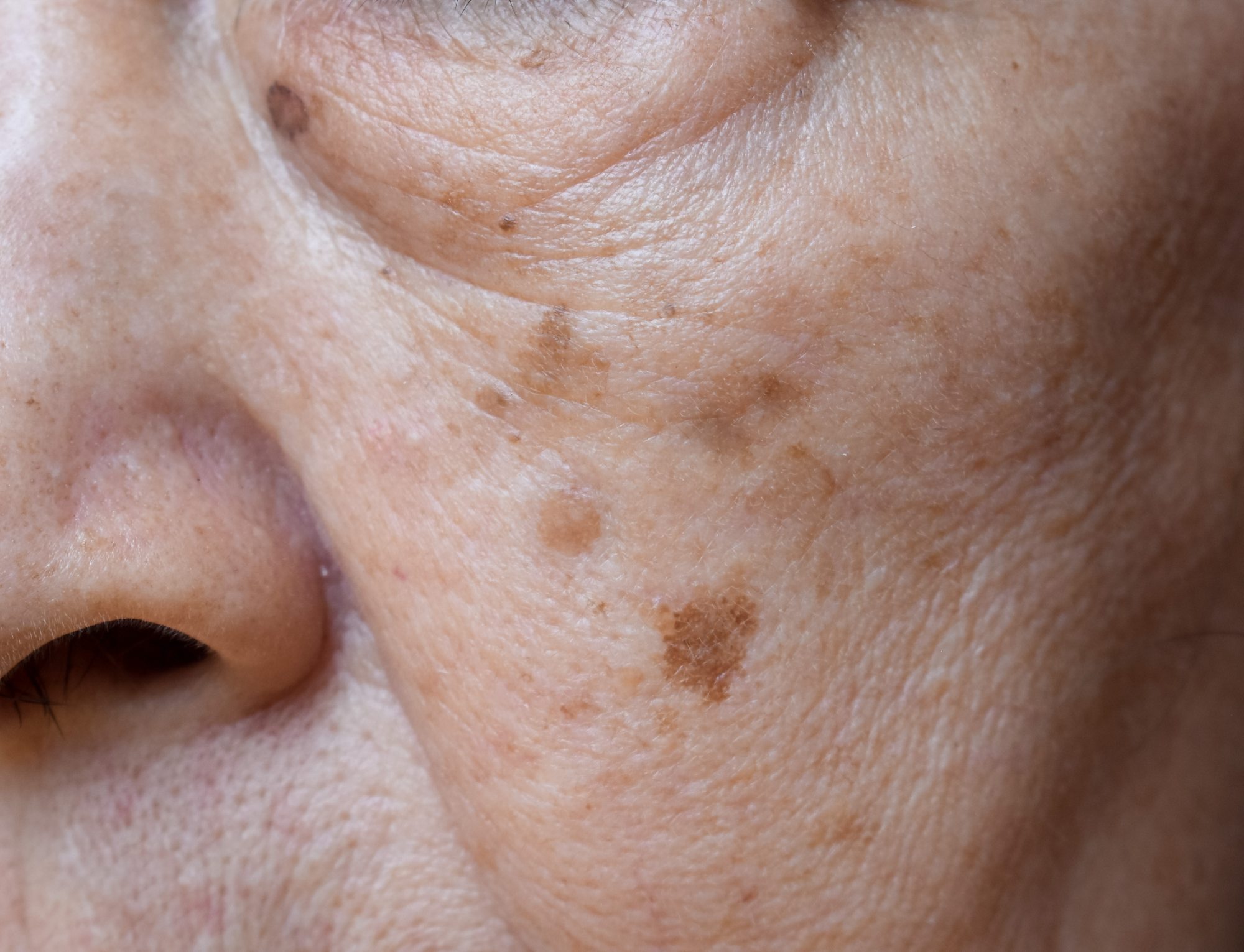 Age spots on an older woman's face.