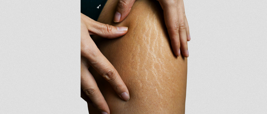 Stretch marks on upper thigh.