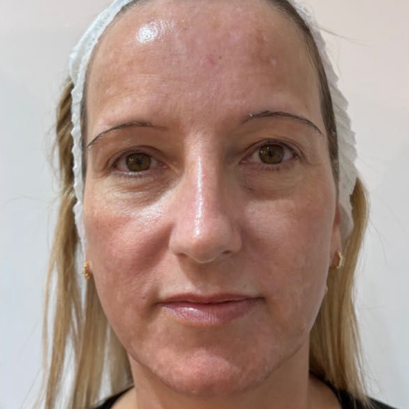After MOXI Treatment