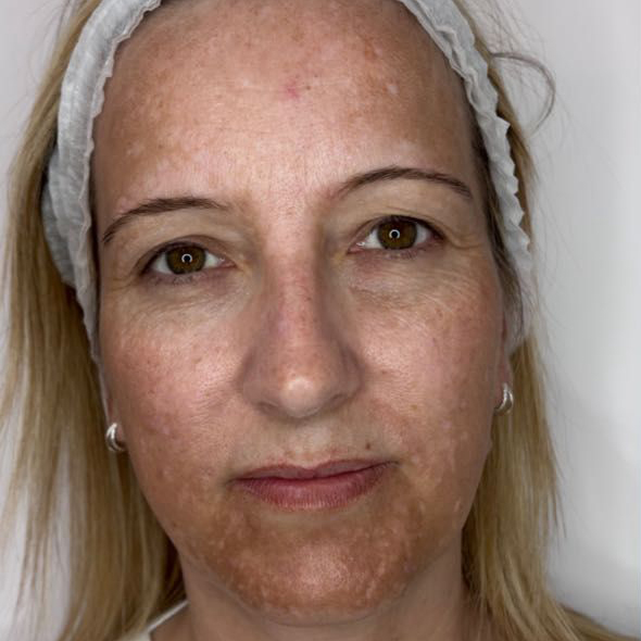 Before MOXI Treatment